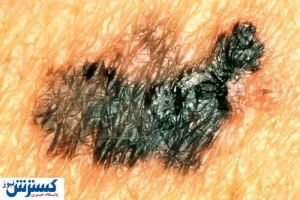 کدام خال‌ها نشانه‌ی سرطانند؟