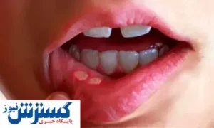 کمبود این ویتامین ها باعث آفت دهان می‌ شود