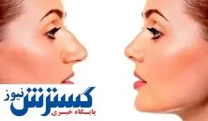 قبل از عمل بینی حتما این کار را انجام دهید