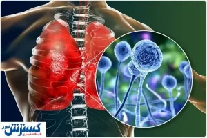 قارچ سیاه چیست؟ + راه درمان