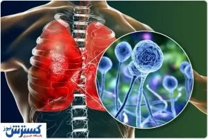 هشدار/ این افراد در معرض ابتلا به بیماری قارچ سیاه هستند!