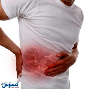 چگونه با آبلیمو سنگ کلیه را دفع کنیم + راه حل موثر
