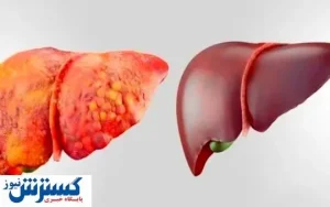 بیماری خطرناک کبد چرب با این علائم می آید