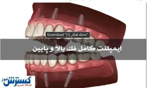 ایمپلنت کامل فک بالا و فک پایین