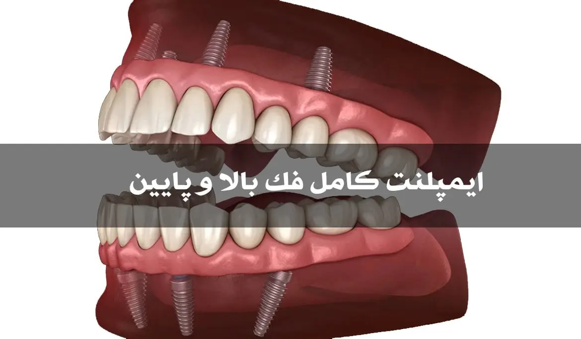 ایمپلنت