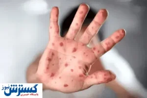 آبله میمون چگونه منتشر می شود؟