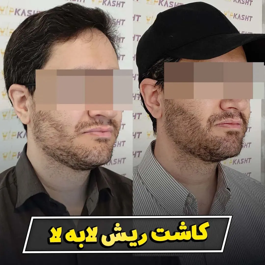 کاشت-ریش