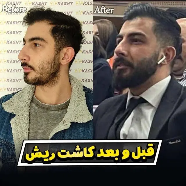 کاشت-مو