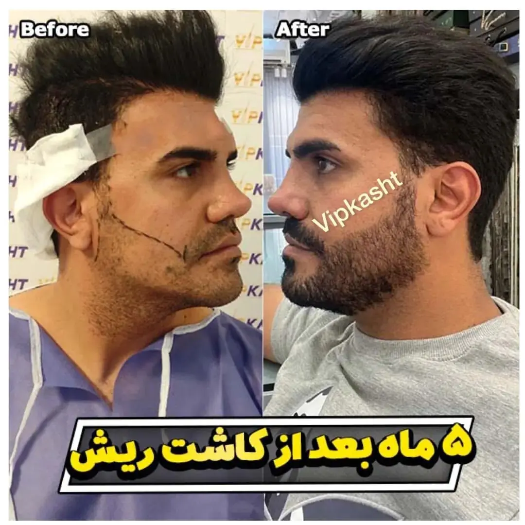 کاشت