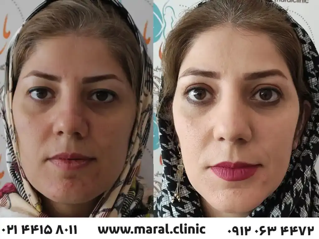 درمان-افتادگی-پلک-۱