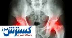 شایعترین علامت  سرطان لگن مشخص شد