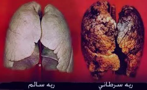 ریه2