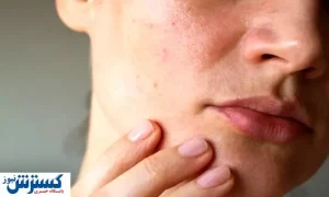 راهکار جلوگیری از شلی پوست بعد از لاغری