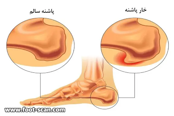خارپاشنه