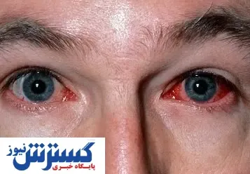 صفر تا صد کرونای چشمی | این افراد بیشتر مراقبت کنند