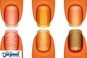 تشخیص سرطان ریه از روی ناخن ممکن شد