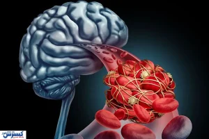 دومین قاتل ایرانیان ؛ اقدامات مهم در تایم طلایی را یاد بگیریم