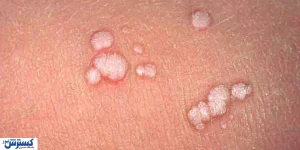 آیا زگیل تناسلی واگیر دارد؟ حقایق علمی درباره انتقال، پیشگیری و HPV