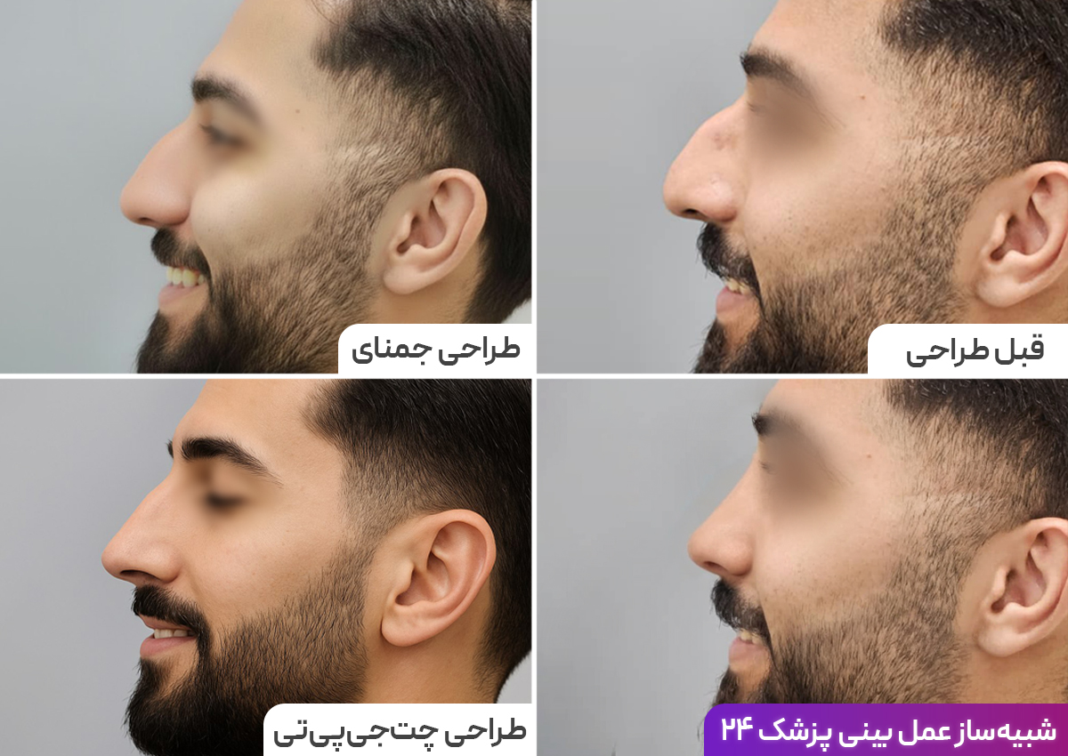 تفاوت طراحی بینی رینوبات پزشک 24 با جمینای و چت جی پی تی