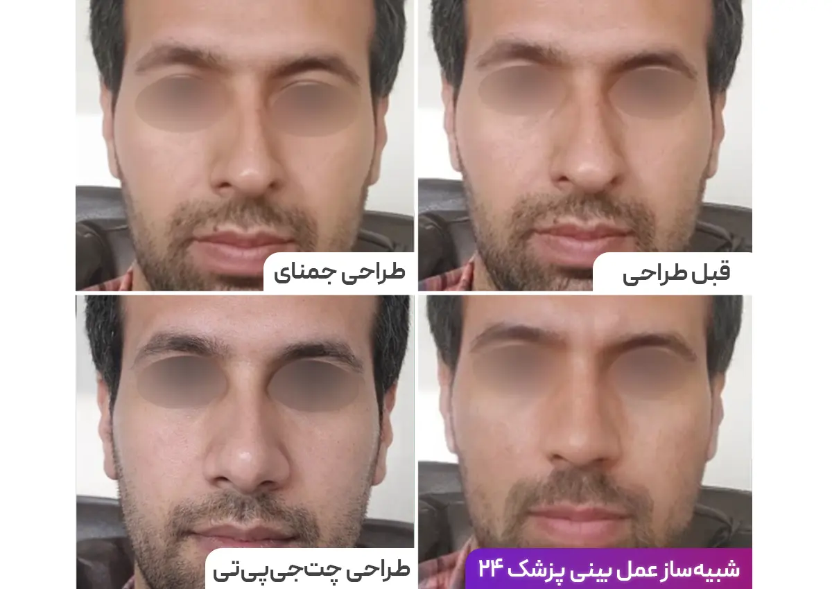 تفاوت رینوبات پزشک 24 در طراحی بینی قبل از عمل با سایر ابزارهای هوش مصنوعی