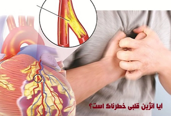 درمان آنژین قلب